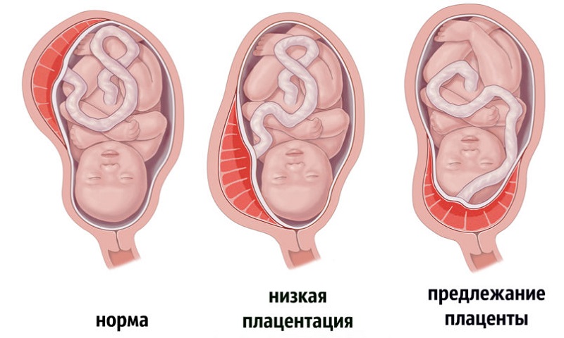 Предлежание плаценты: чем опасно и как исправить. Обязательно ли кесарево сечение при краевом предлежании плаценты. На каком сроке беременности определяют предлежание плаценты.