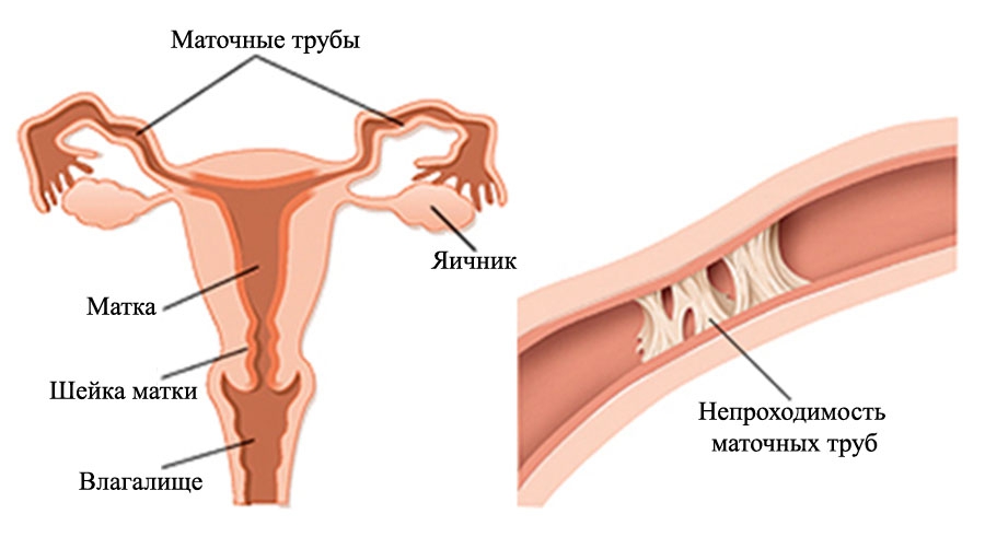 Проходимость маточных труб: как влияет на возможность зачатия. Как проверяют проходимость маточных труб. Лапароскопия маточных труб как способ лечения бесплодия. Гистеросальпингография фаллопиевых труб.