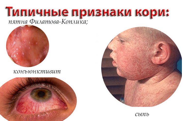 Эпидемия кори. как делать прививки от кори взрослым. Симптомы кори у детей и взрослых и вакцинация от кори. Вспышка кори в июне 2018 года в Новосибирске.