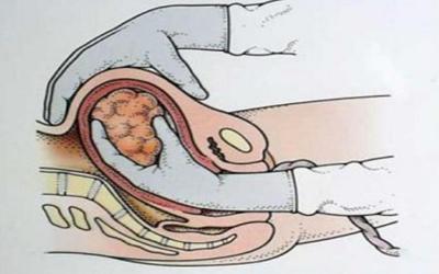 Приращение плаценты: истинное и ложное. Когда необходимо ручное отделение плаценты после родов. Чем грозит плотное прикрепление плаценты. Осложнения после ручного отделения плаценты.