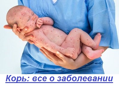 Эпидемия кори. как делать прививки от кори взрослым. Симптомы кори у детей и взрослых и вакцинация от кори. Вспышка кори в феврале 2019 года в Новосибирске.