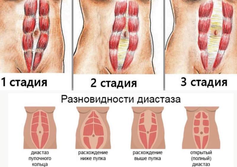Диастаз прямых мышц живота после родов. Как диагностировать диастаз, можно ли убрать диастаз при помощи физических упражнений, нужно ли носить бандаж при диастазе. Операция по ушиванию диастаза в Новосибирске.