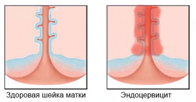 Заболевания внутренней части шейки матки