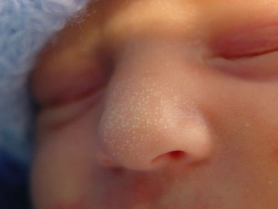 Описание наиболее часто беспокоящих родителей проблем, относящихся к внешности новорожденного.