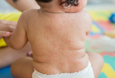 Почему возникает сыпь у детей. Часть 2. Сыпь при инфекционных и аллергических заболеваниях