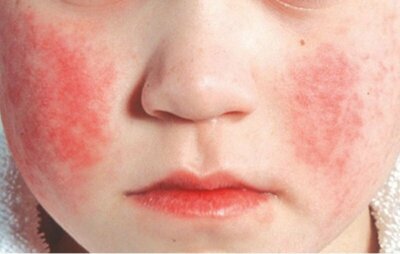 Почему возникает сыпь у детей. Часть 2. Сыпь при инфекционных и аллергических заболеваниях