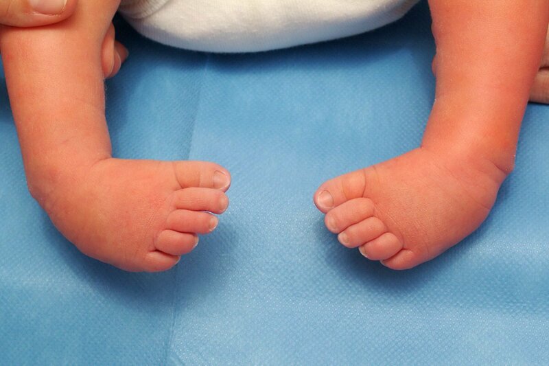 Согласно статистике, три новорожденных из тысячи появляются на свет с косолапостью, то есть врожденной аномалией строения суставов стоп и голеностопа.