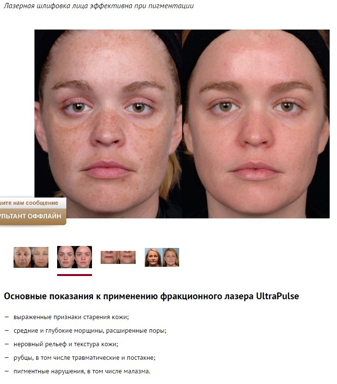 Лечение пигментации на лице - цены и описание процедуры в Москве, фото До и После